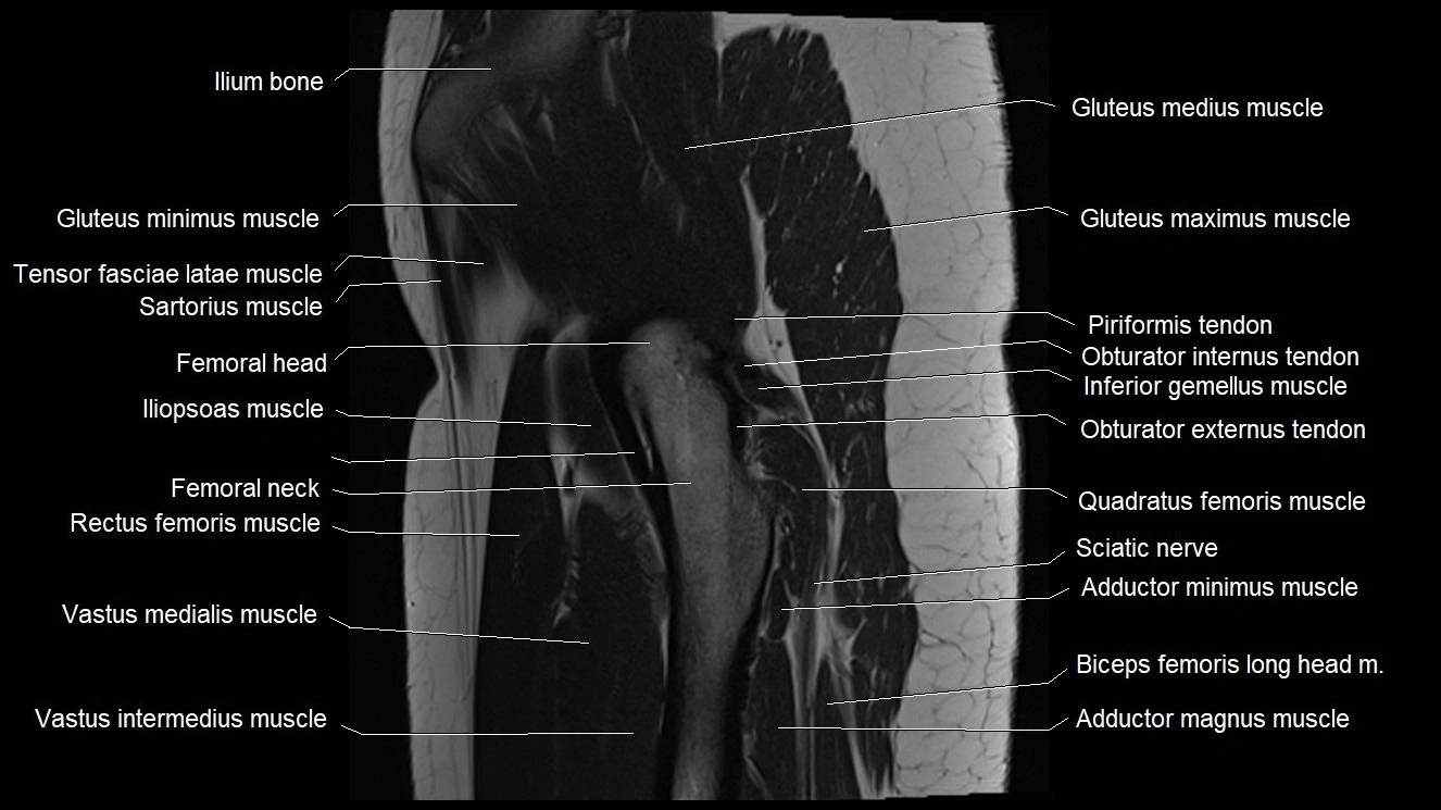 Hip sagittal cross sectional anatomy image 14.webp